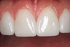 The image shows a close-up view of a person s teeth with an overlay of a split screen showing a before and after comparison, emphasizing dental whitening results.