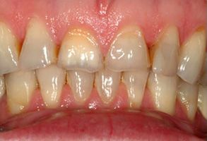 The image shows two photographs of a person s teeth with yellowing and staining, suggesting poor oral hygiene or advanced dental issues requiring professional attention.