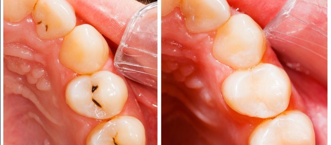Composite Tooth-Colored Fillings